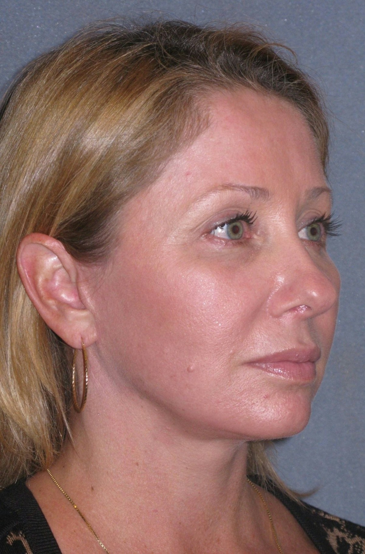 Mini Lift & Neck Lift Before & After Gallery - Patient 130421 - Image 4