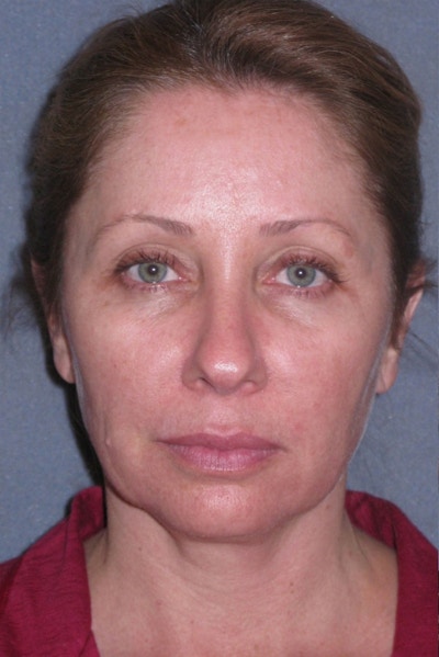 Mini Lift & Neck Lift Before & After Gallery - Patient 130421 - Image 1