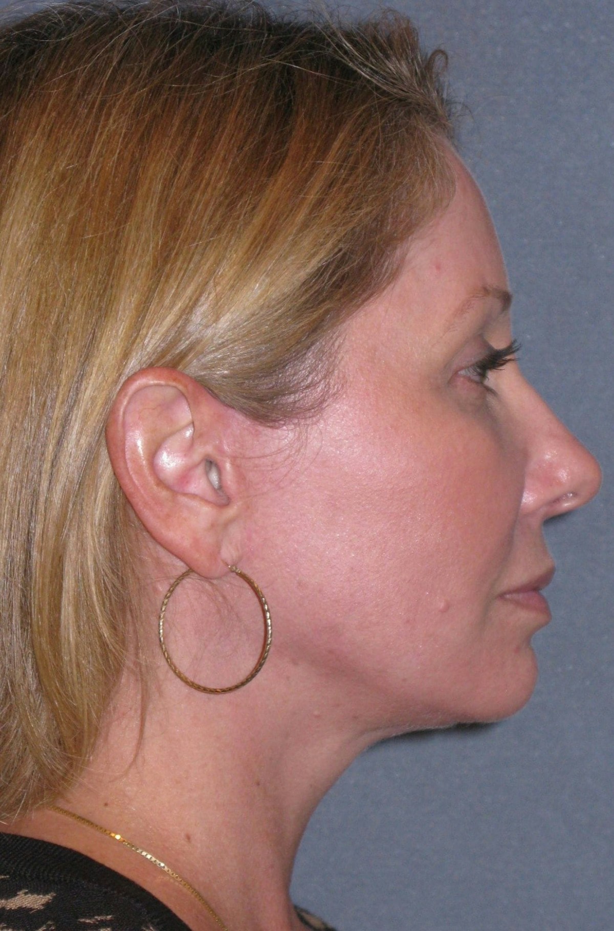 Mini Lift & Neck Lift Before & After Gallery - Patient 130421 - Image 6