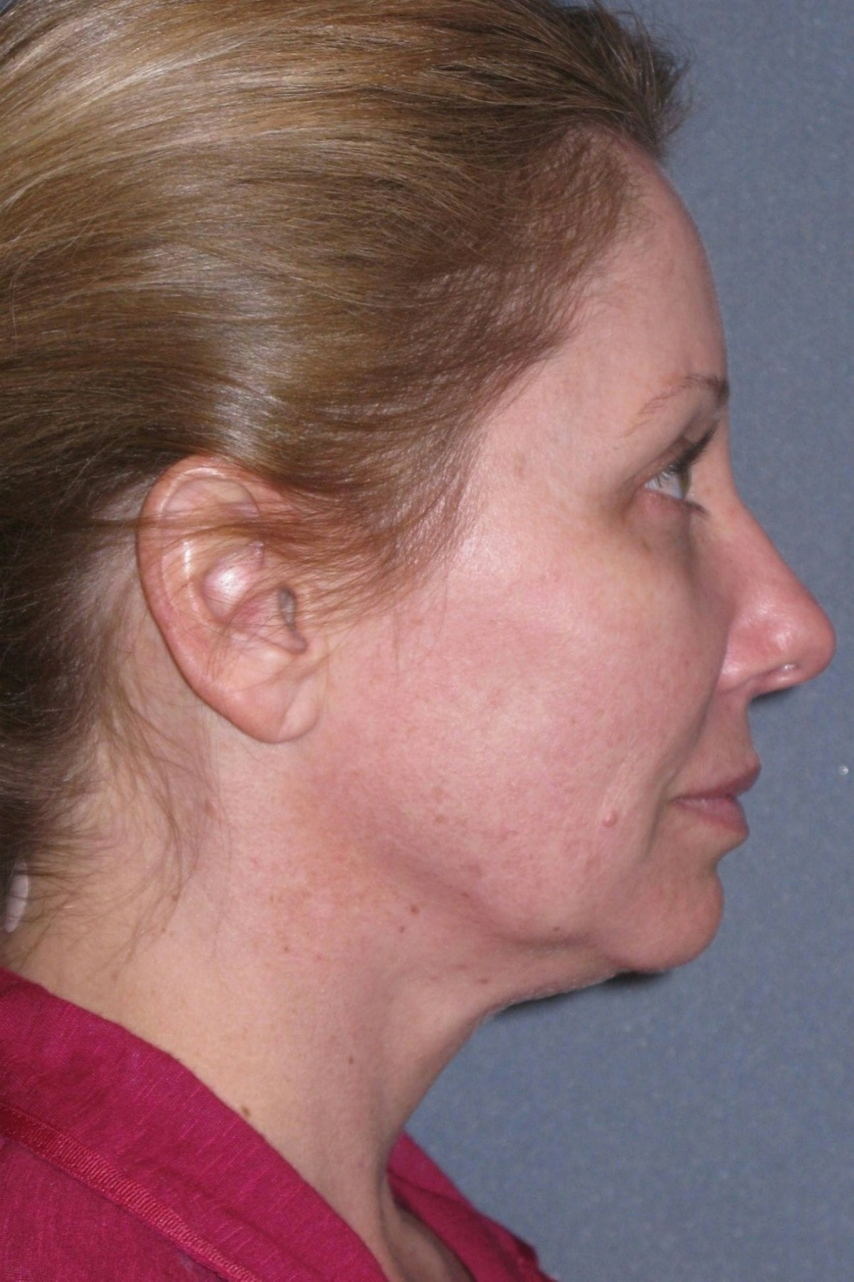 Mini Lift & Neck Lift Before & After Gallery - Patient 130421 - Image 5