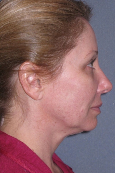 Lower Face/Neck Lift Over Time Before & After Gallery - Patient 342278 - Image 1