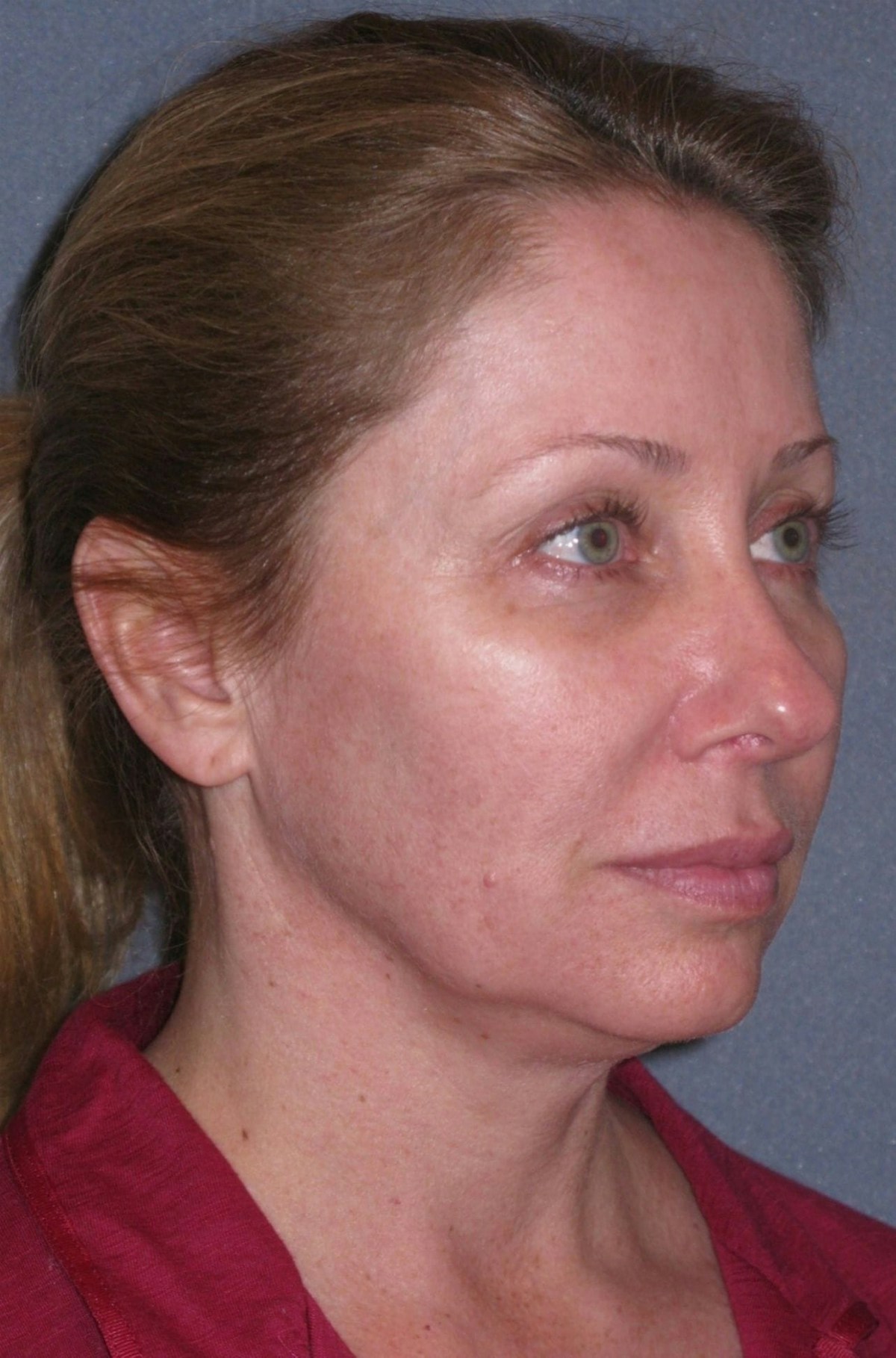Mini Lift & Neck Lift Before & After Gallery - Patient 130421 - Image 3