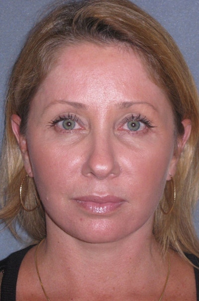 Mini Lift & Neck Lift Before & After Gallery - Patient 130421 - Image 2