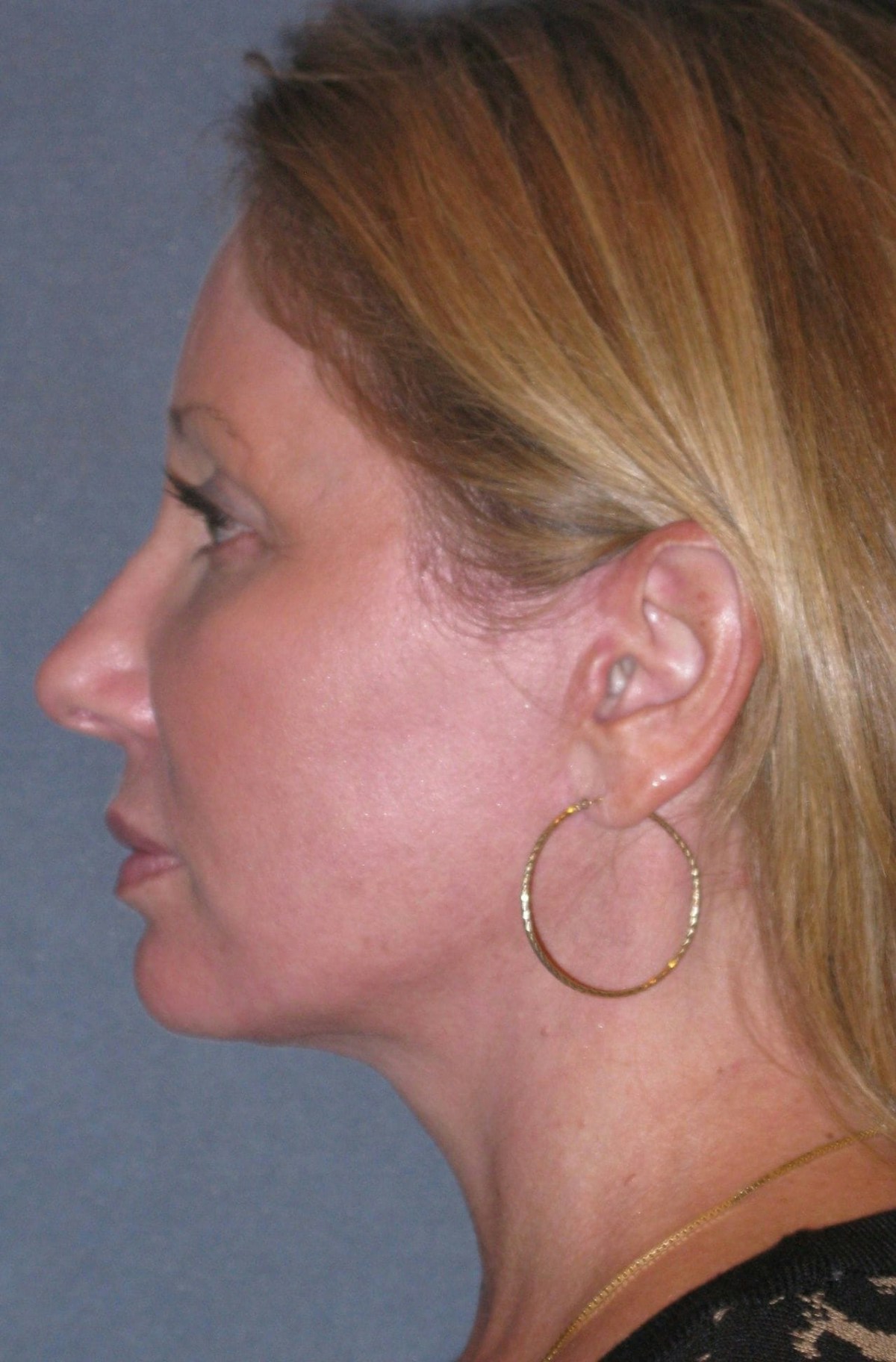 Mini Lift & Neck Lift Before & After Gallery - Patient 130421 - Image 8
