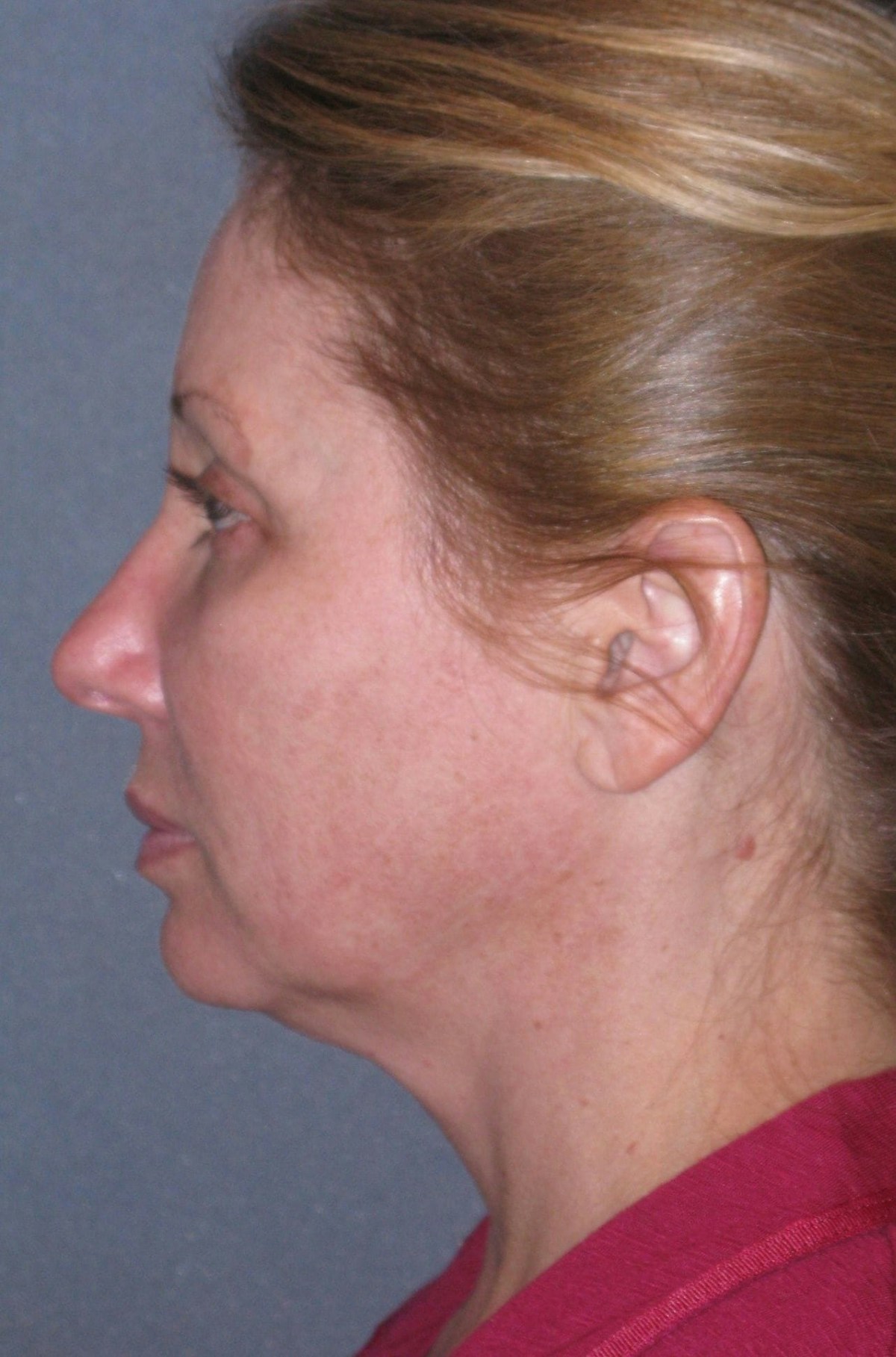 Mini Lift & Neck Lift Before & After Gallery - Patient 130421 - Image 7