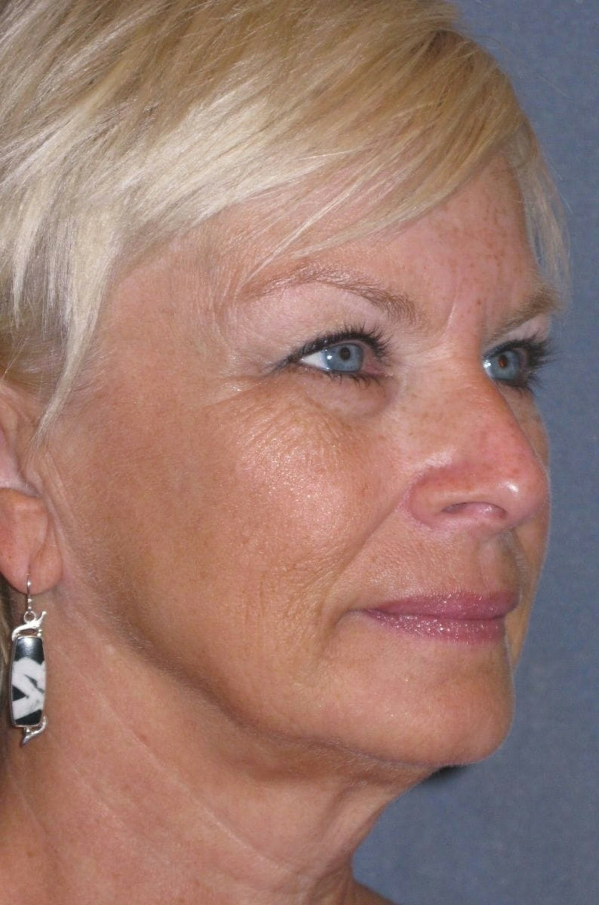 Mini Lift & Neck Lift Before & After Gallery - Patient 454242 - Image 3