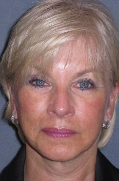 Mini Lift & Neck Lift Before & After Gallery - Patient 454242 - Image 2