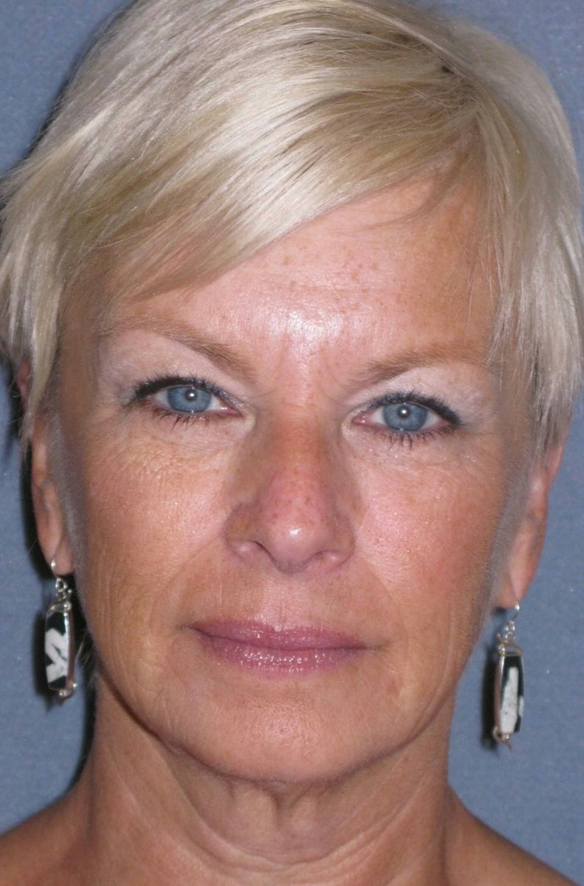 Mini Lift & Neck Lift Before & After Gallery - Patient 454242 - Image 1