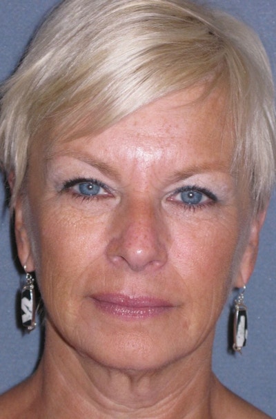 Mini Lift & Neck Lift Before & After Gallery - Patient 454242 - Image 1