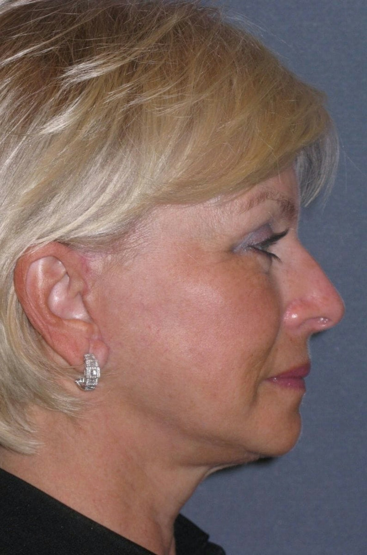 Mini Lift & Neck Lift Before & After Gallery - Patient 454242 - Image 6