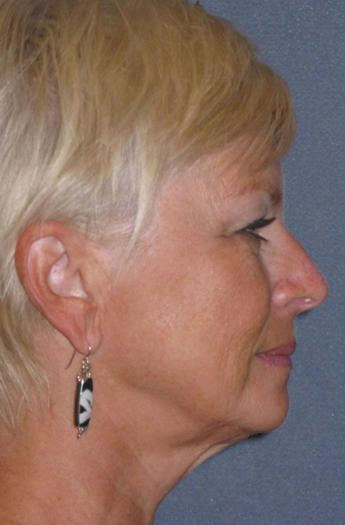 Mini Lift & Neck Lift Before & After Gallery - Patient 454242 - Image 5