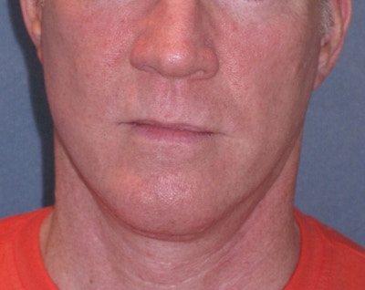 Mini Lift & Neck Lift Before & After Gallery - Patient 188155 - Image 2