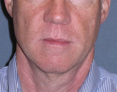 Mini Lift & Neck Lift Before & After Gallery - Patient 188155 - Image 1