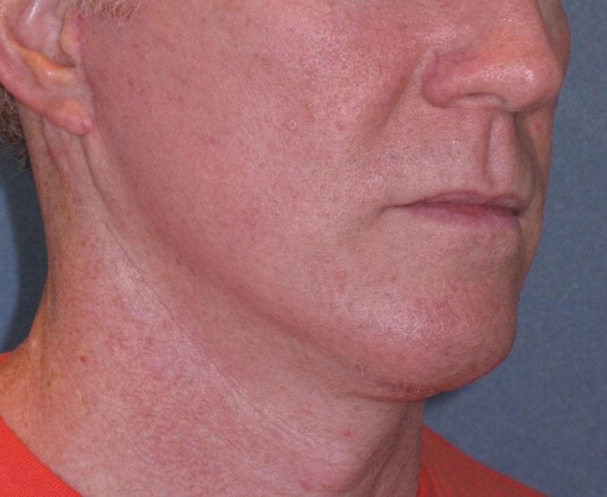Mini Lift & Neck Lift Before & After Gallery - Patient 188155 - Image 4
