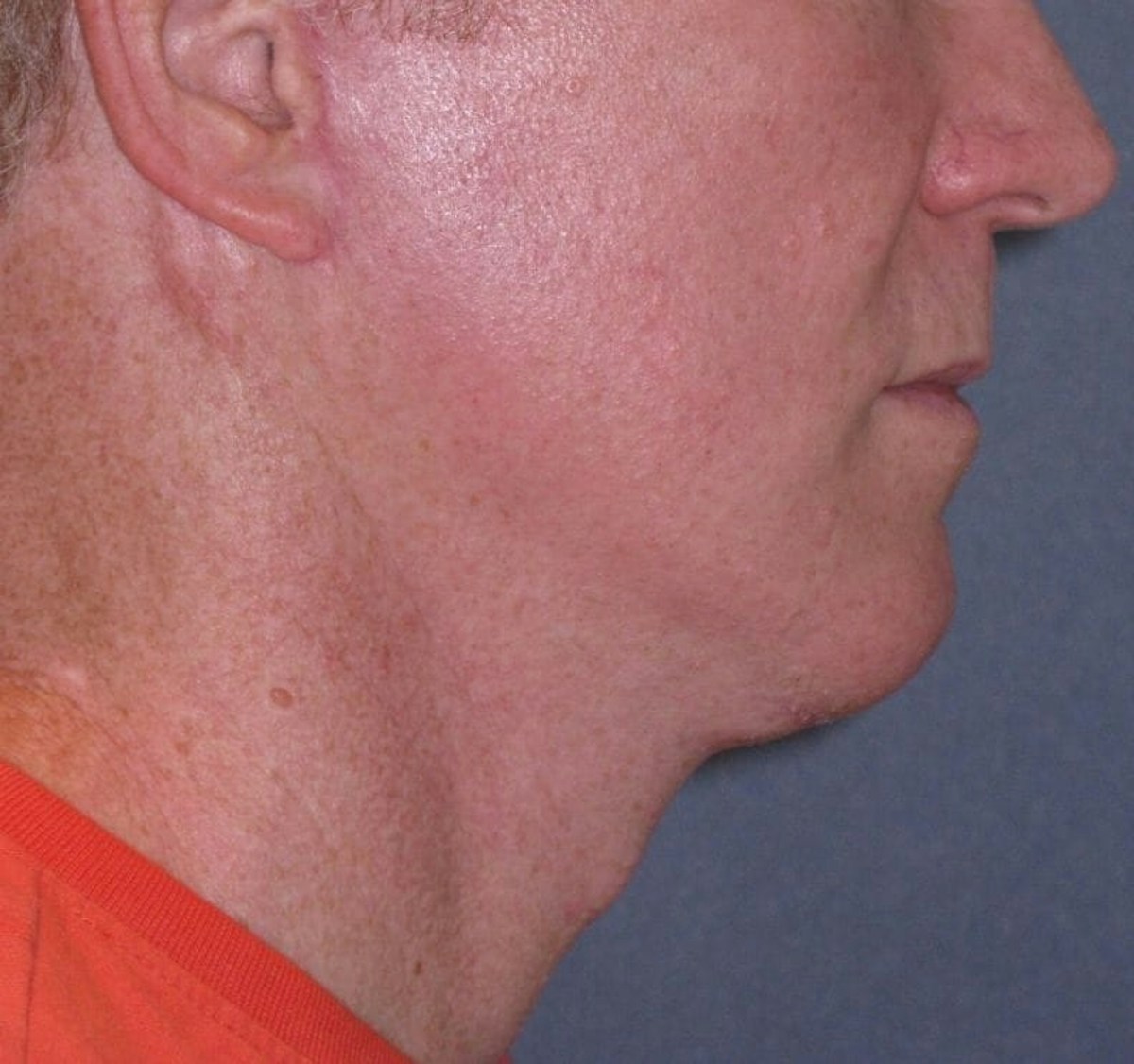 Mini Lift & Neck Lift Before & After Gallery - Patient 188155 - Image 6