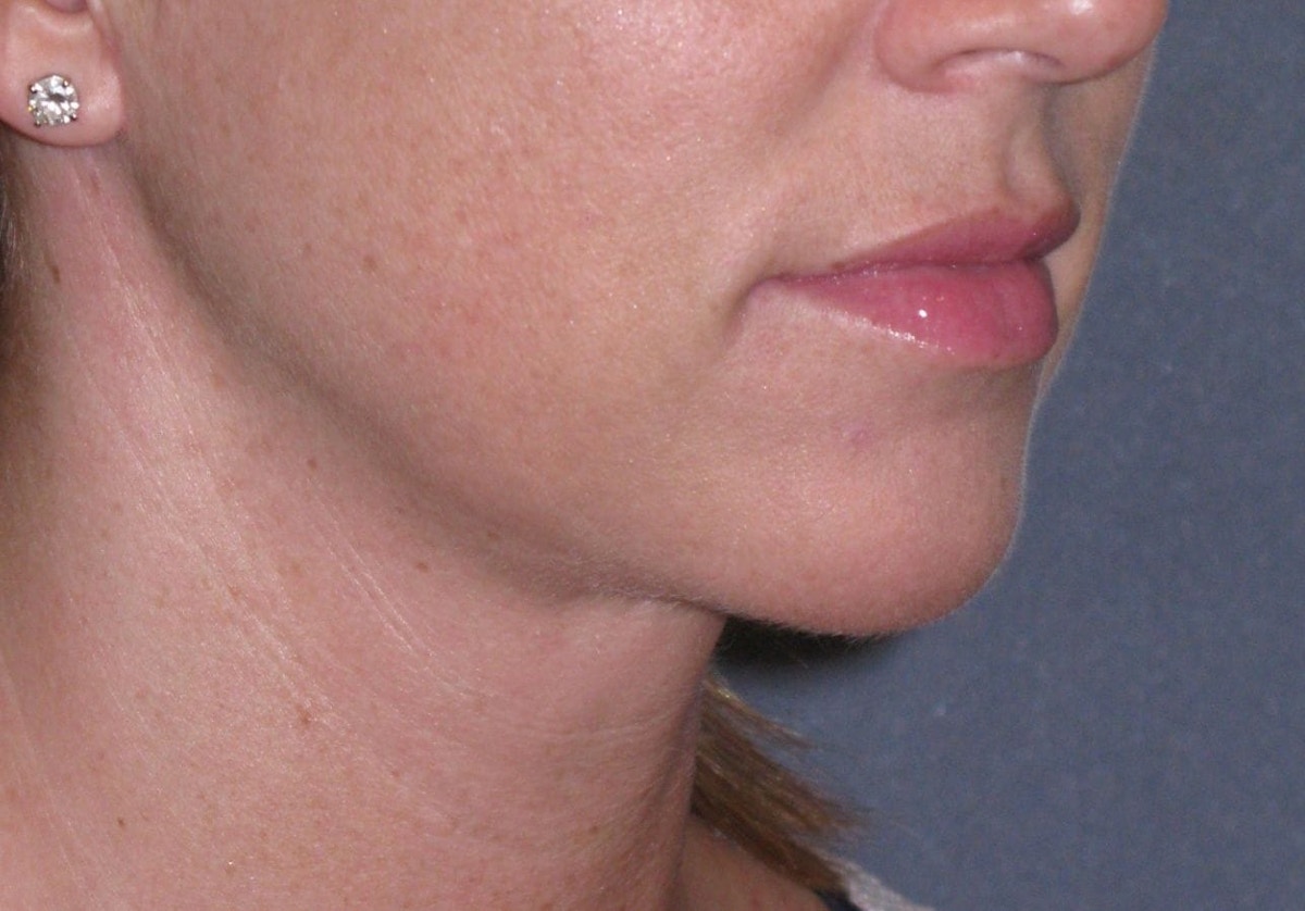 Neck Lift Before & After Gallery - Patient 206081 - Image 1