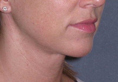 Neck Lift Before & After Gallery - Patient 206081 - Image 1