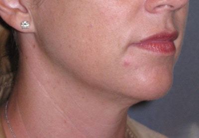 Neck Lift Before & After Gallery - Patient 206081 - Image 2