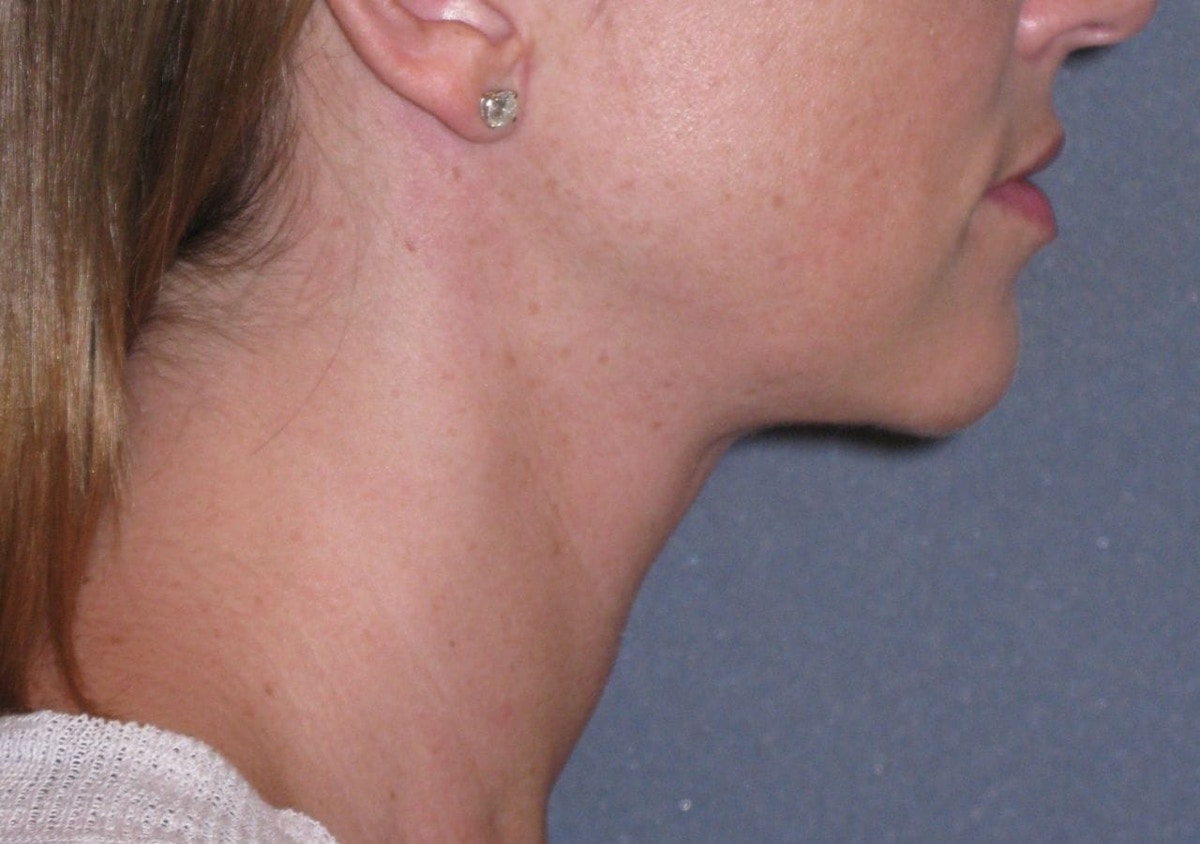 Neck Lift Before & After Gallery - Patient 206081 - Image 4