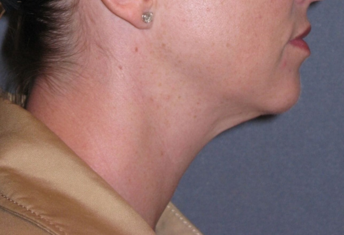 Neck Lift Before & After Gallery - Patient 206081 - Image 3
