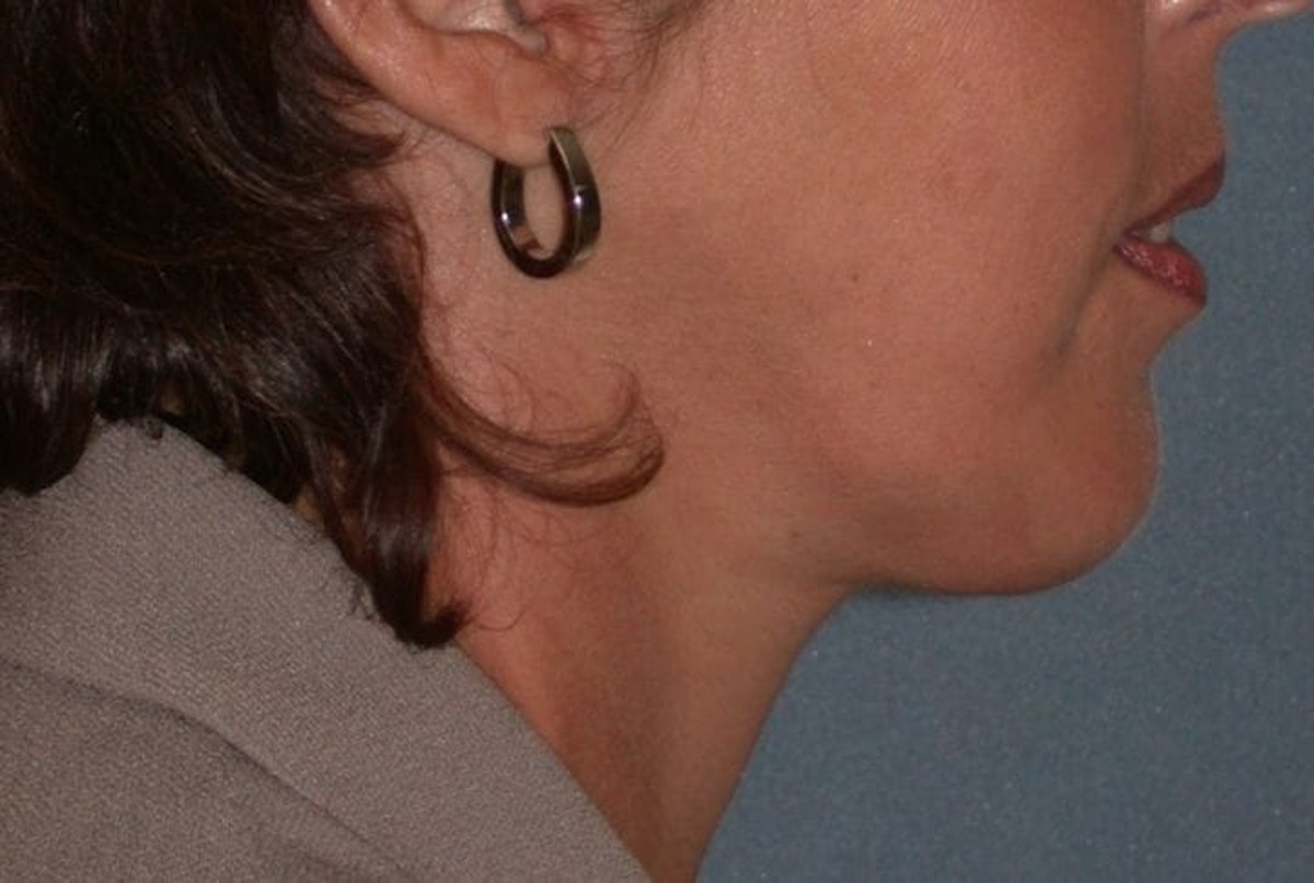 Neck Lift Before & After Gallery - Patient 173770 - Image 2