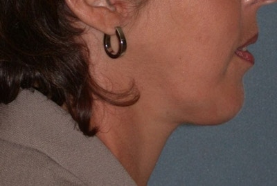 Neck Lift Before & After Gallery - Patient 173770 - Image 2