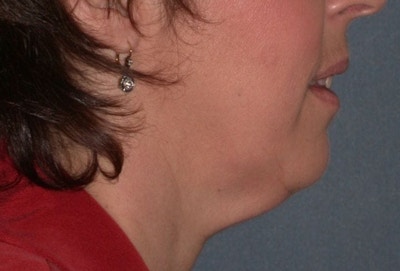 Neck Lift Before & After Gallery - Patient 173770 - Image 1