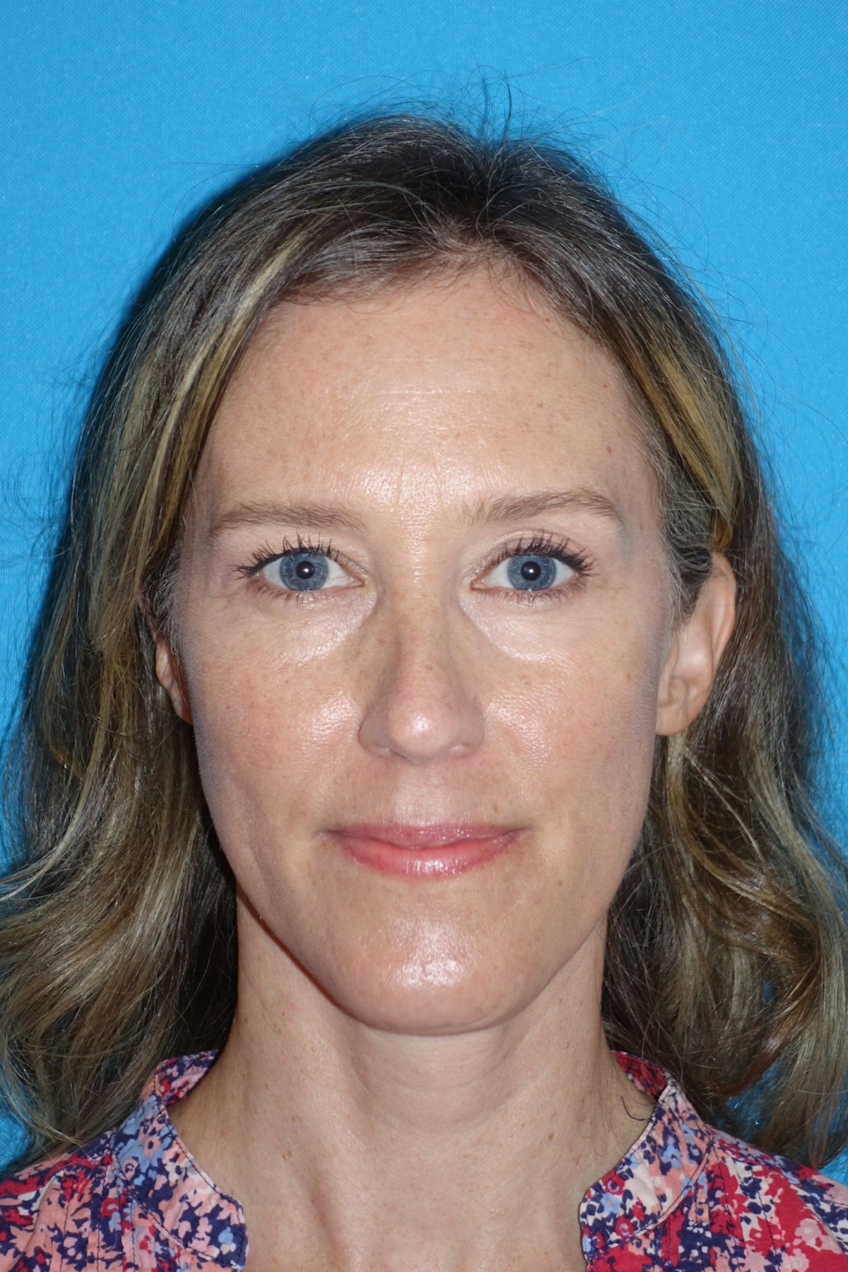 Rhinoplasty Before & After Gallery - Patient 429257 - Image 2