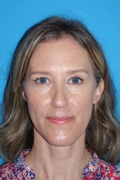 Rhinoplasty Before & After Gallery - Patient 429257 - Image 2