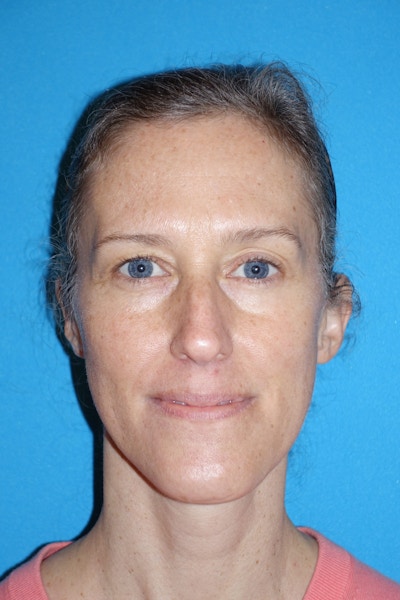 Rhinoplasty Before & After Gallery - Patient 429257 - Image 1