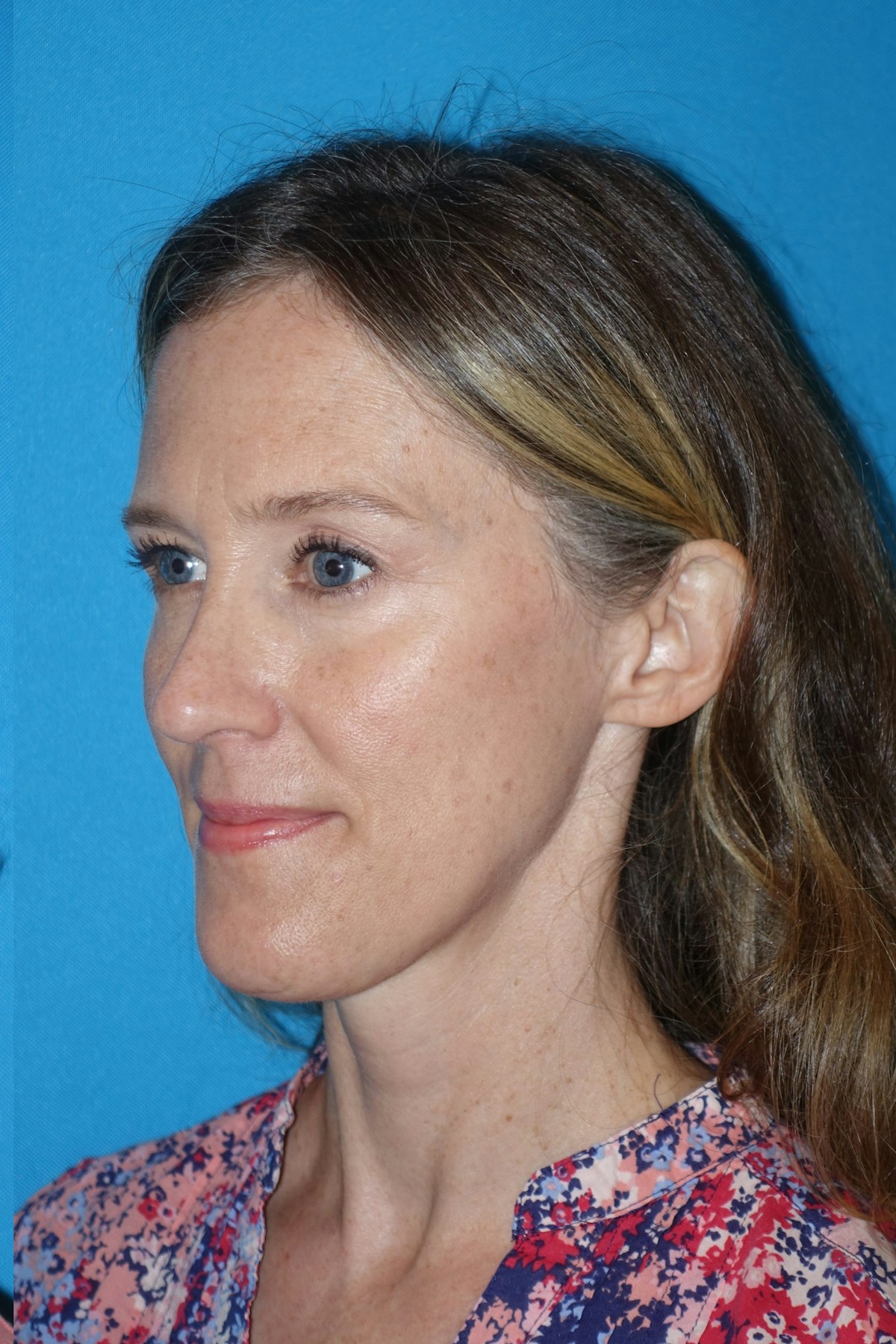 Rhinoplasty Before & After Gallery - Patient 429257 - Image 4