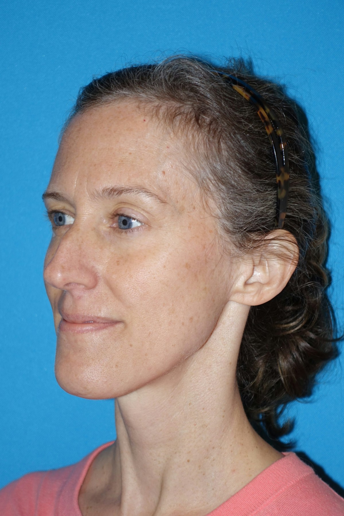 Rhinoplasty Before & After Gallery - Patient 429257 - Image 3