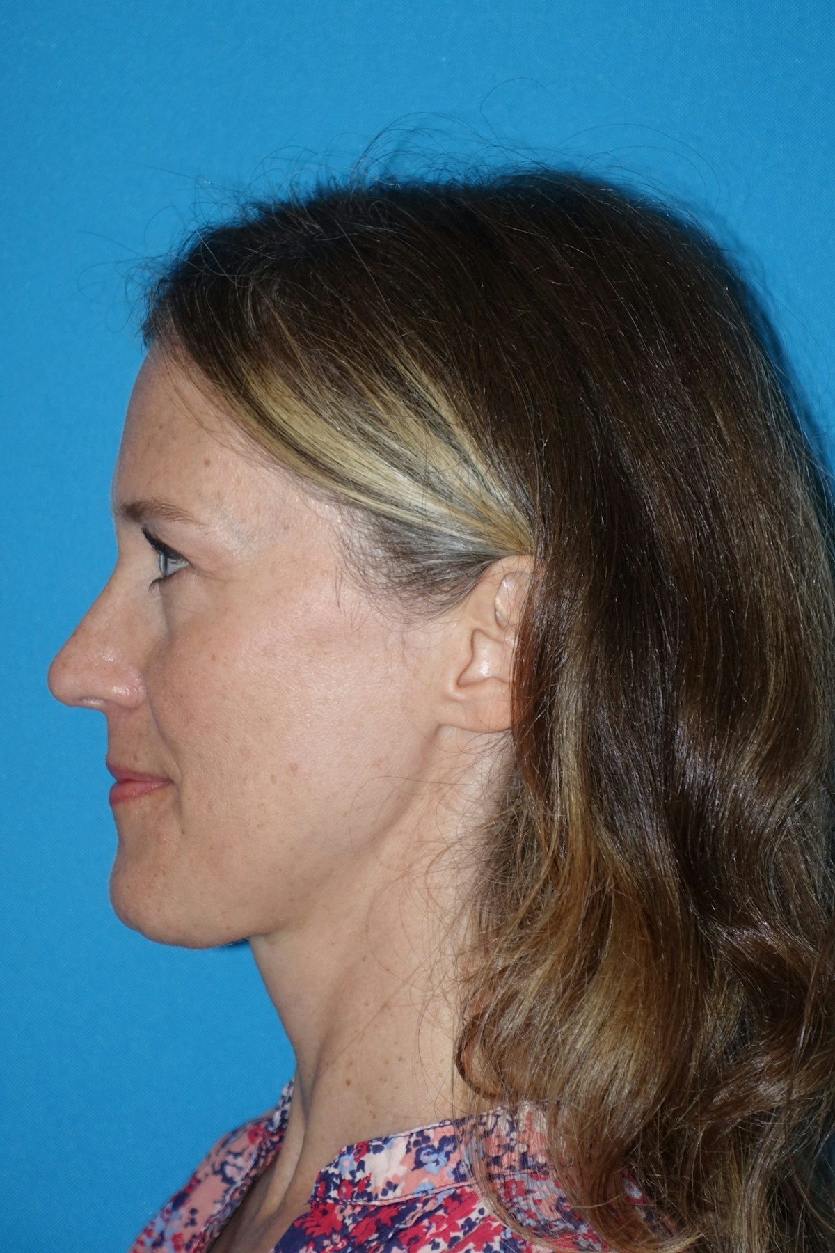 Rhinoplasty Before & After Gallery - Patient 429257 - Image 6