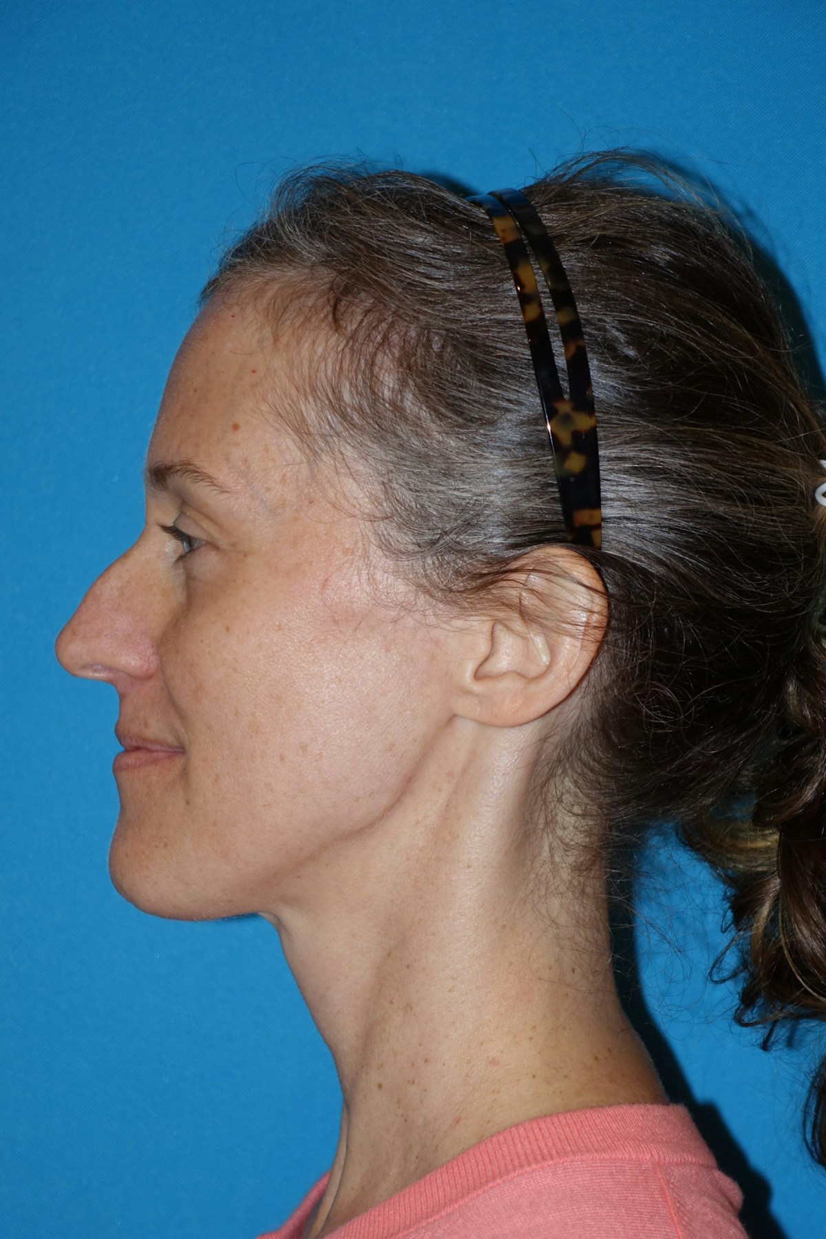 Rhinoplasty Before & After Gallery - Patient 429257 - Image 5