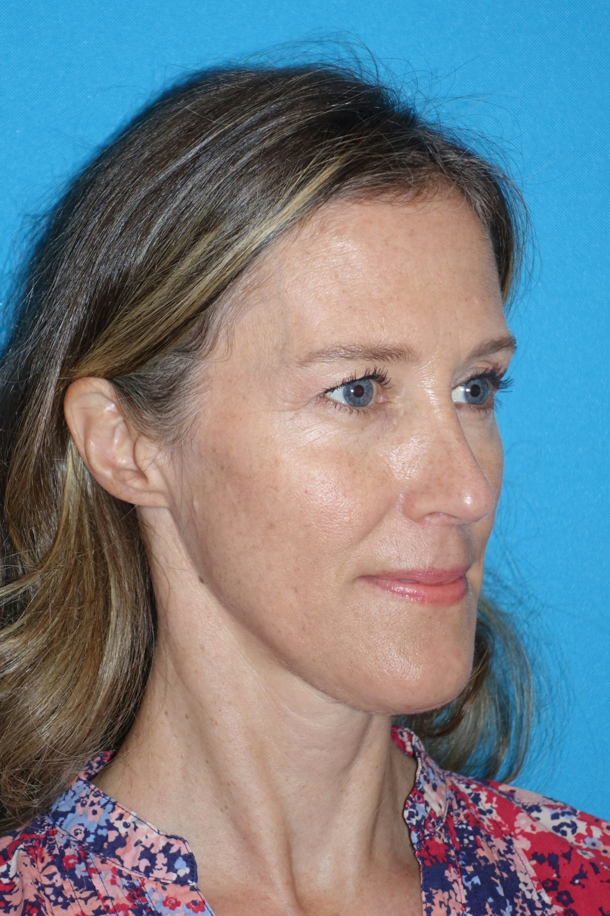 Rhinoplasty Before & After Gallery - Patient 429257 - Image 8