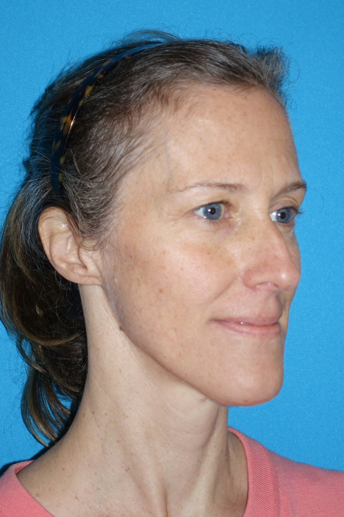 Rhinoplasty Before & After Gallery - Patient 429257 - Image 7