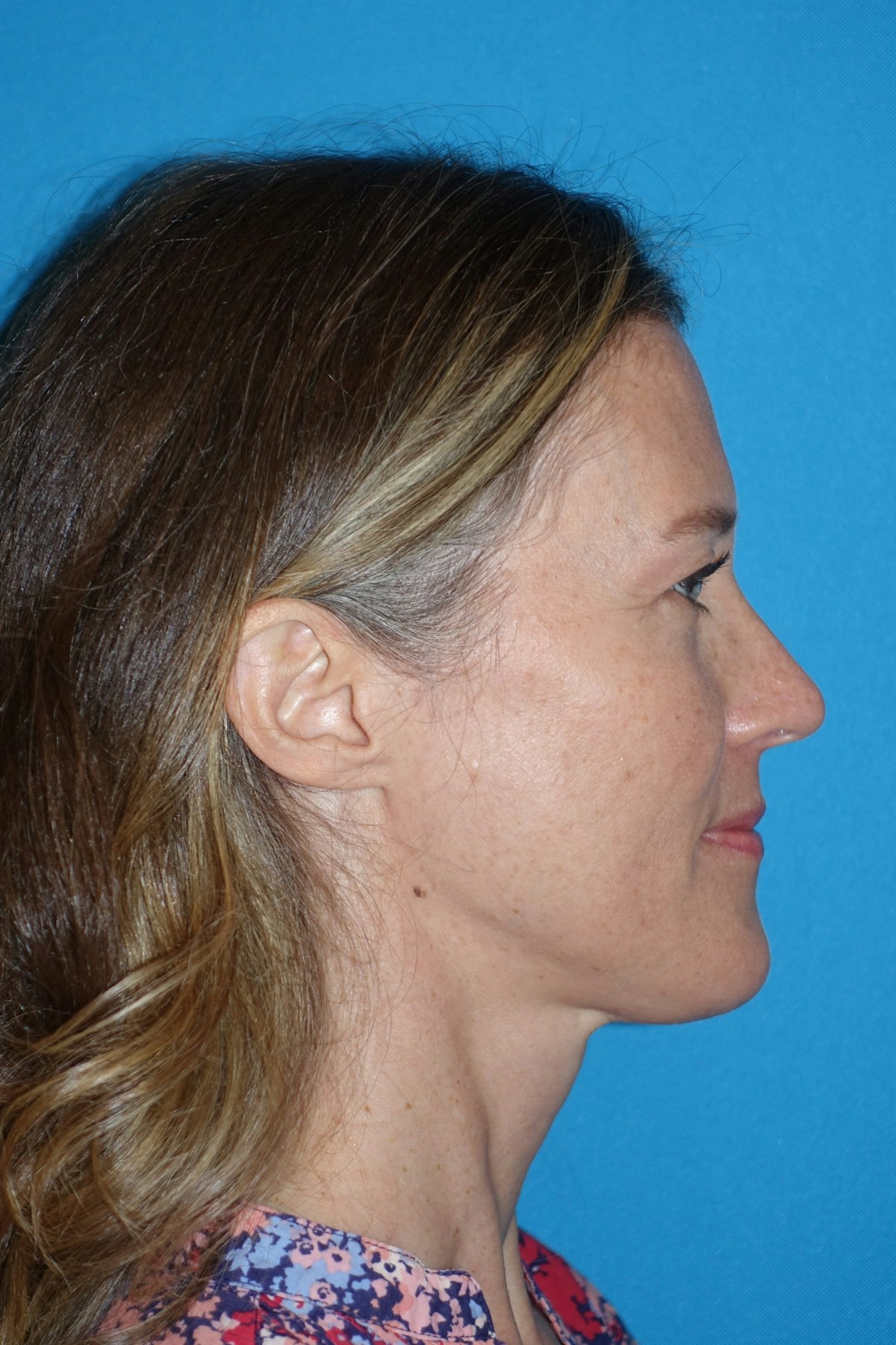 Rhinoplasty Before & After Gallery - Patient 429257 - Image 9