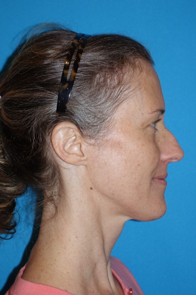 Rhinoplasty Before & After Gallery - Patient 429257 - Image 1