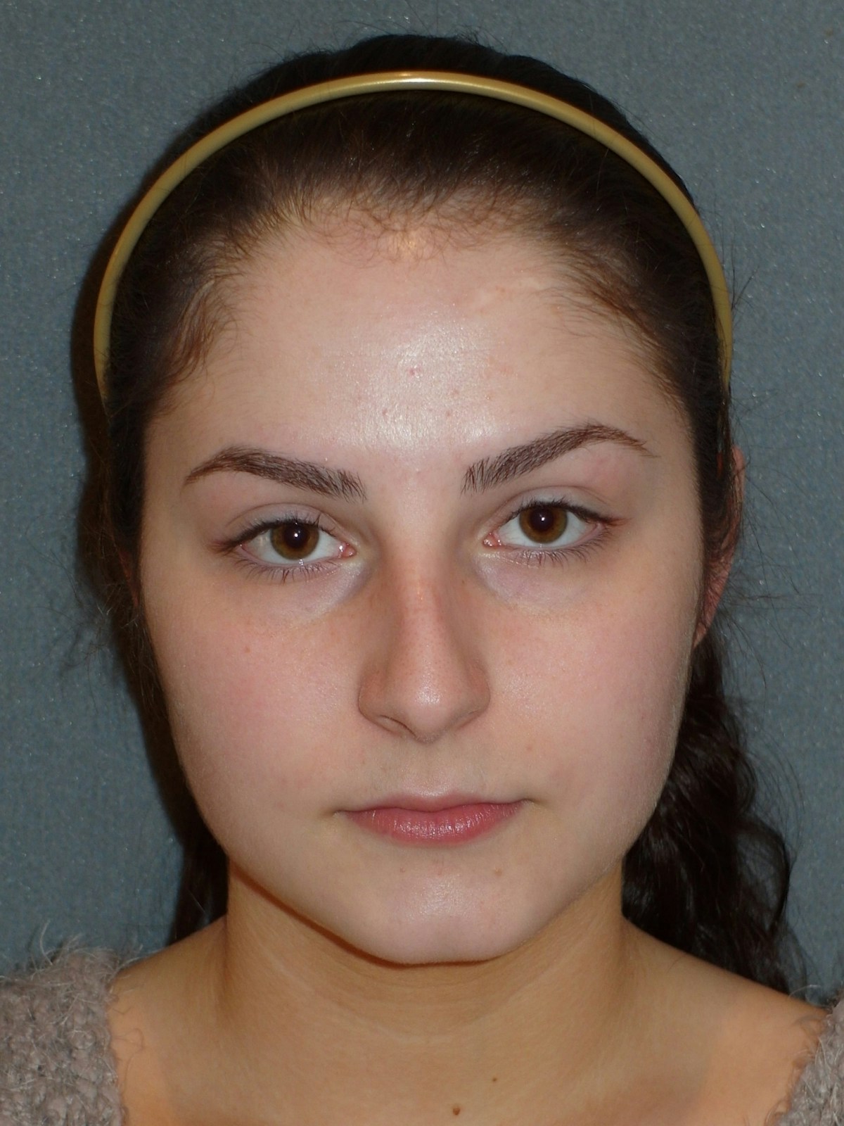 Rhinoplasty Before & After Gallery - Patient 604759 - Image 1