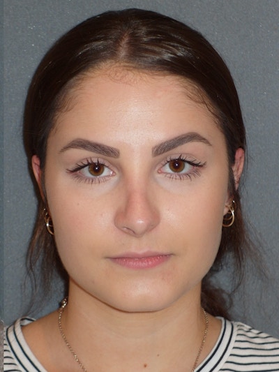 Rhinoplasty Before & After Gallery - Patient 604759 - Image 2
