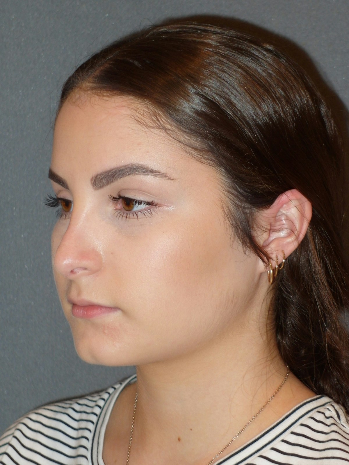 Rhinoplasty Before & After Gallery - Patient 604759 - Image 8