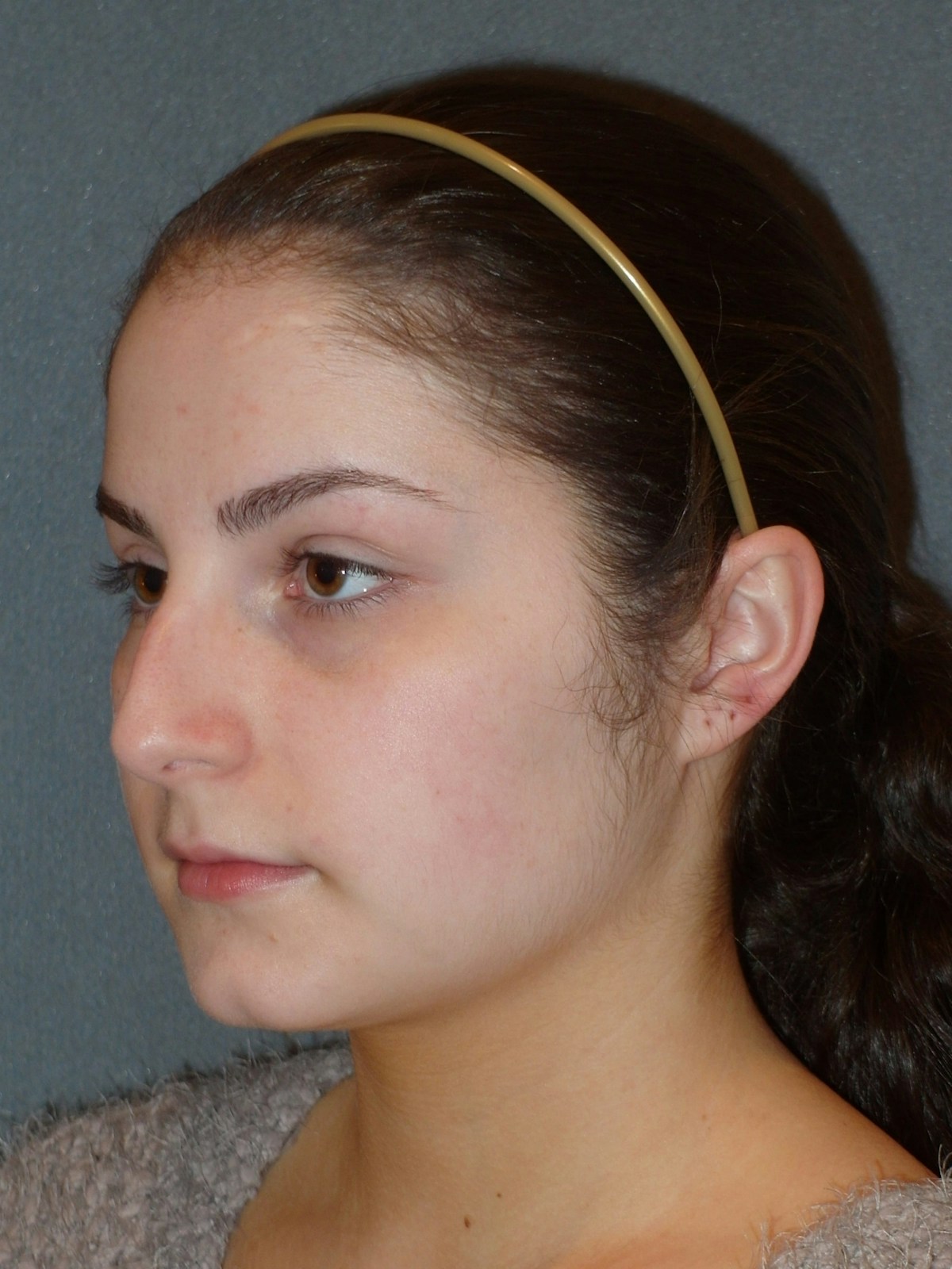 Rhinoplasty Before & After Gallery - Patient 604759 - Image 7