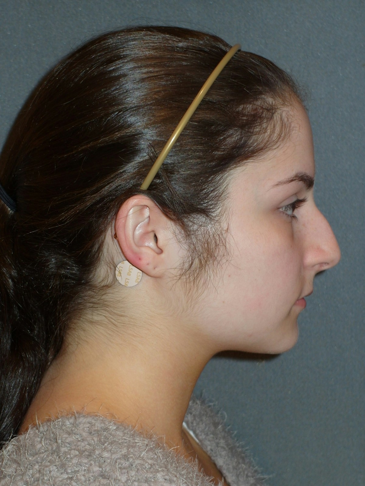 Rhinoplasty Before & After Gallery - Patient 604759 - Image 5