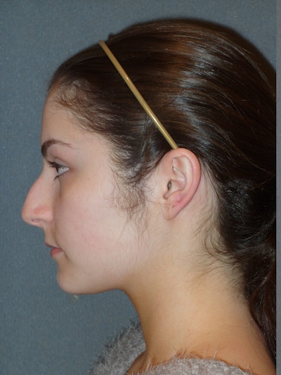 Rhinoplasty Before & After Gallery - Patient 604759 - Image 1