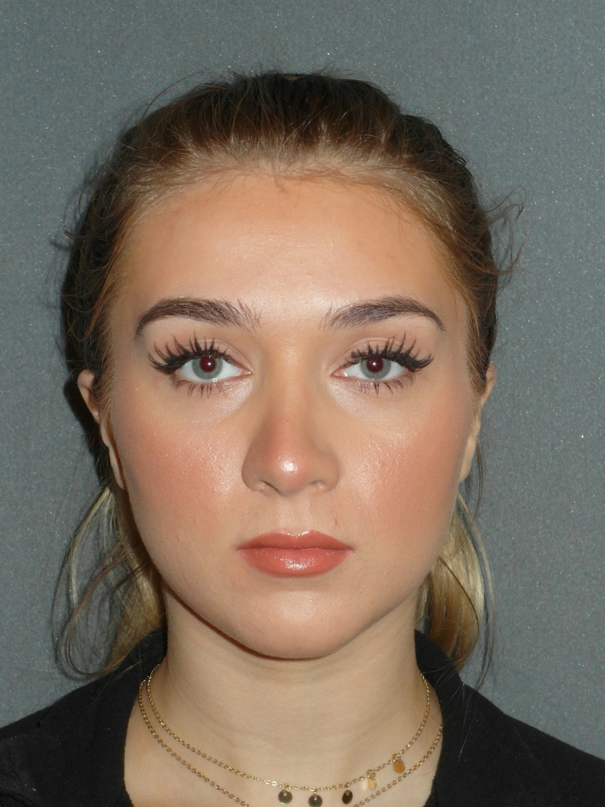 Rhinoplasty Before & After Gallery - Patient 208247 - Image 2