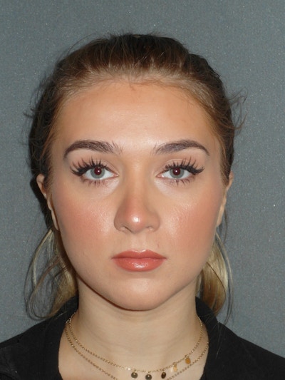 Rhinoplasty Before & After Gallery - Patient 208247 - Image 2