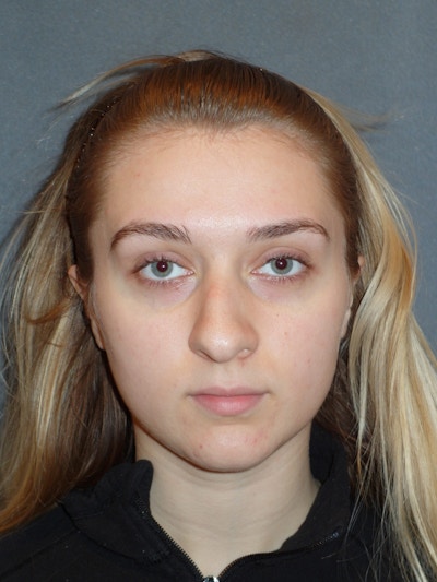 Rhinoplasty Before & After Gallery - Patient 208247 - Image 1