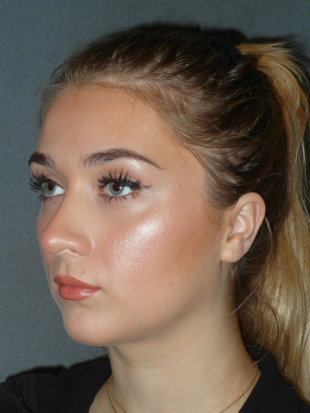 Rhinoplasty Before & After Gallery - Patient 208247 - Image 4