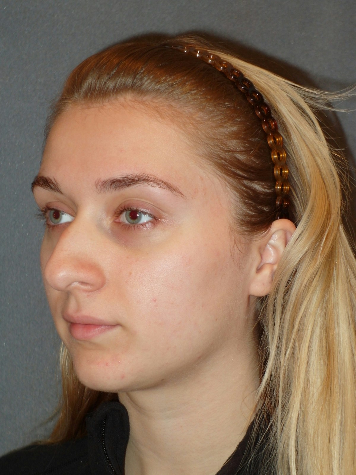 Rhinoplasty Before & After Gallery - Patient 208247 - Image 3