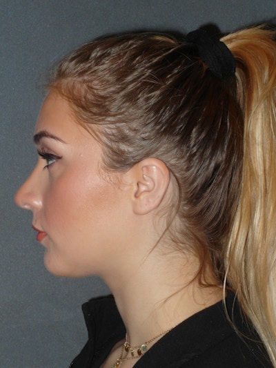 Rhinoplasty Before & After Gallery - Patient 208247 - Image 2